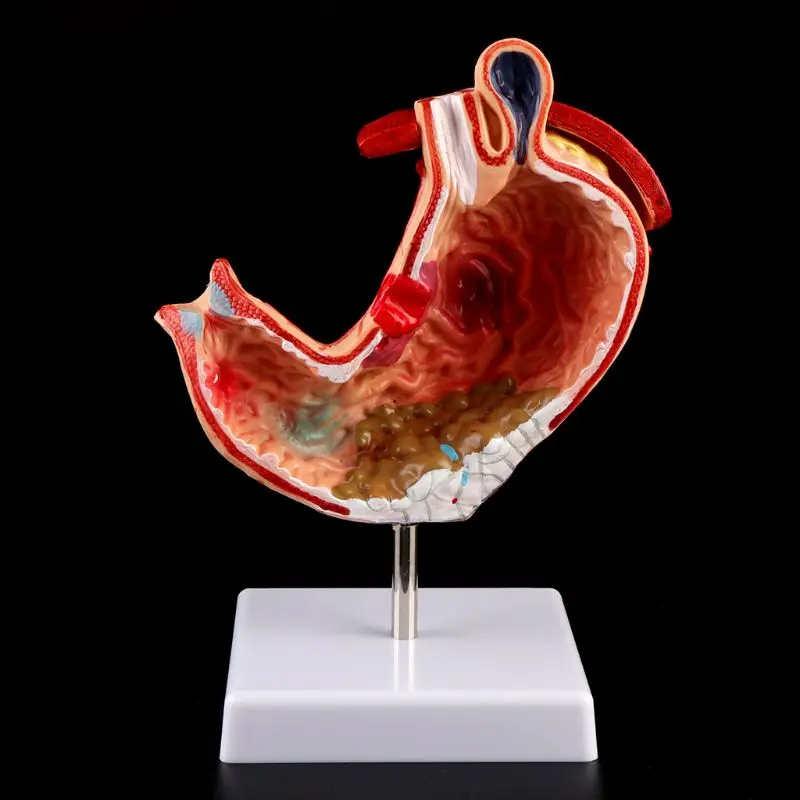 

1 PC Stomach Human Anatomical Anatomy Stomach Medical Model Gastric Pathology Gastritis Ulcer Medical Teaching Learning Tool