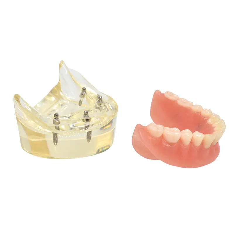 Mandibulares com Implante de Dente Modelo Teeth Dental Overdenture Removível Interior Mandibular Inferior Estudo Ensino Modelo Dentes 13 Cheap Modelo de Ensino Dental