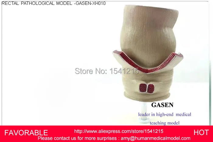 

HUMAN EDUCATION ANATOMY RECTUM PATHOLOGIES MODEL,PATHOLOGICAL MODEL OF RECTUM,RECTUM PATHOLOGICAL RECTUM MODEL-GASEN-XH010