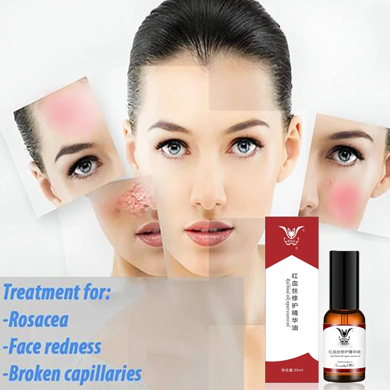 Anti Spider Vein Oil Face Redness Soluation Red Blood Silk ...