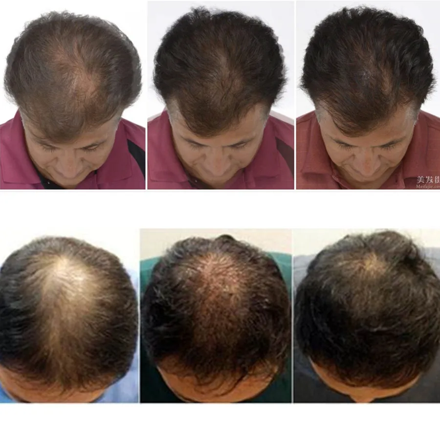 Polygonum Multiflorum White Hair Barba Black And Grow Growth