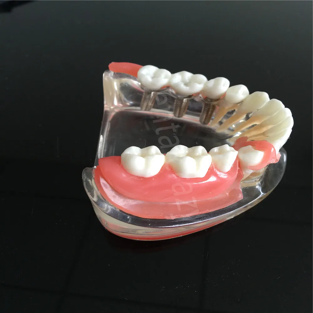 Зубная мандибль имплантат сверхпротез модель зубов с сосудов Demo 6006 модель зубов