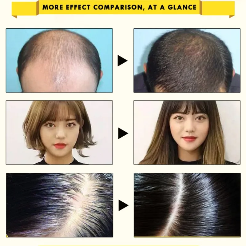 20 мл женьшень Уход за волосами эссенция лечение мужчин t для мужчин женщин выпадение волос быстрая мощная Сыворотка для роста волос