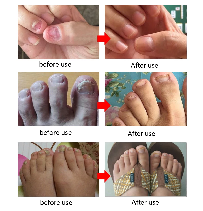 EFERO защита для ногтей Toe крем для ухода за кожей грибок для ногтей Уход восстановление крем для ногтей Питательный гель осветляет