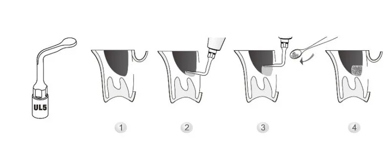 3 шт. UL5, стоматологический наконечник для снятия зубного камня имплантата sinus подъемный наконечник для Дровосек ULTRASURGERY/MECTRON пьезохирургии