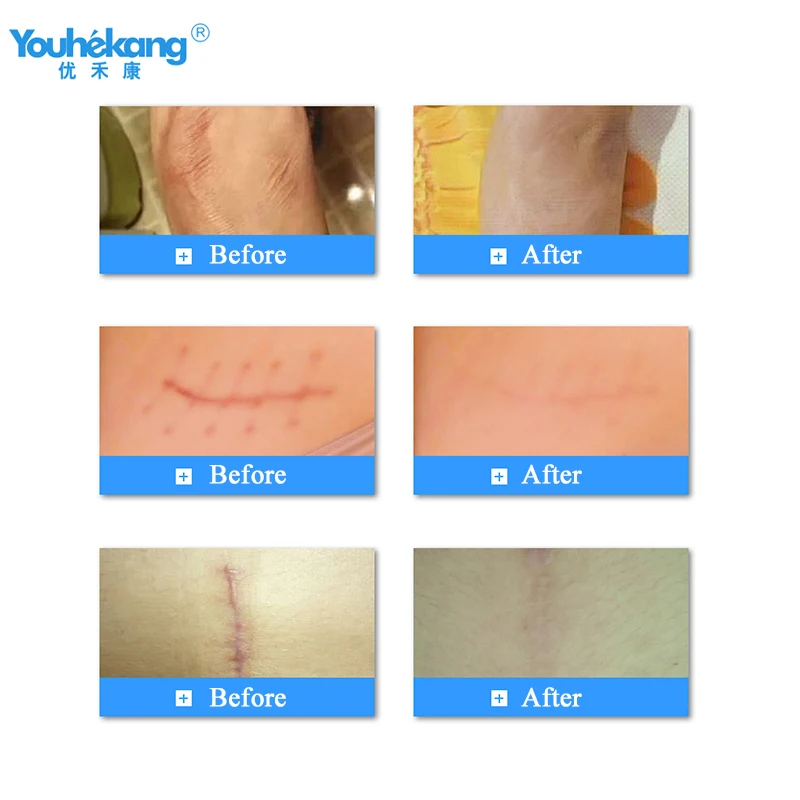 Youhekang мазь от рубцов шрамов пластырь scar plaster лечебные мази face plasters|Пластыри