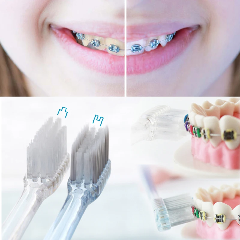Orthodontic Toothbrush DuPont Bristles and Antibacterial Soft Bristles with Silver Ions Concave & Convex 2 Pcs/Set