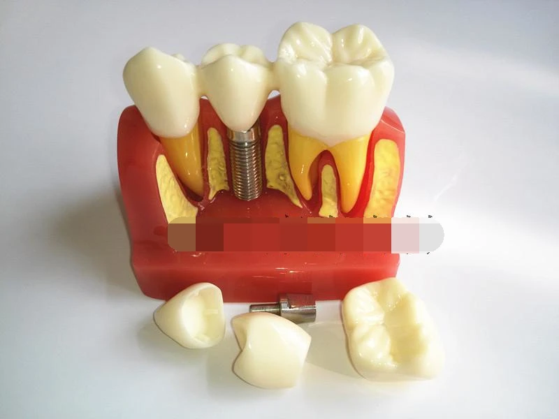 

High Quality 4 Times Dental Teeth Implant Model for Doctor-Patient Demonstration and Porcelain Bridge Restoration