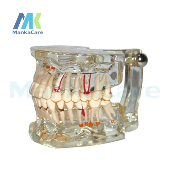 Cuidar-modelo com Metade do Implante Manka Patologia Oral Modelo Dente Dentes
