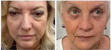 1x 2x 5x 10x 20x Boto x Instantly Ageless Argireline Face Lift Skin Care Product  Powerful Anti-wrinkle Anti-aging