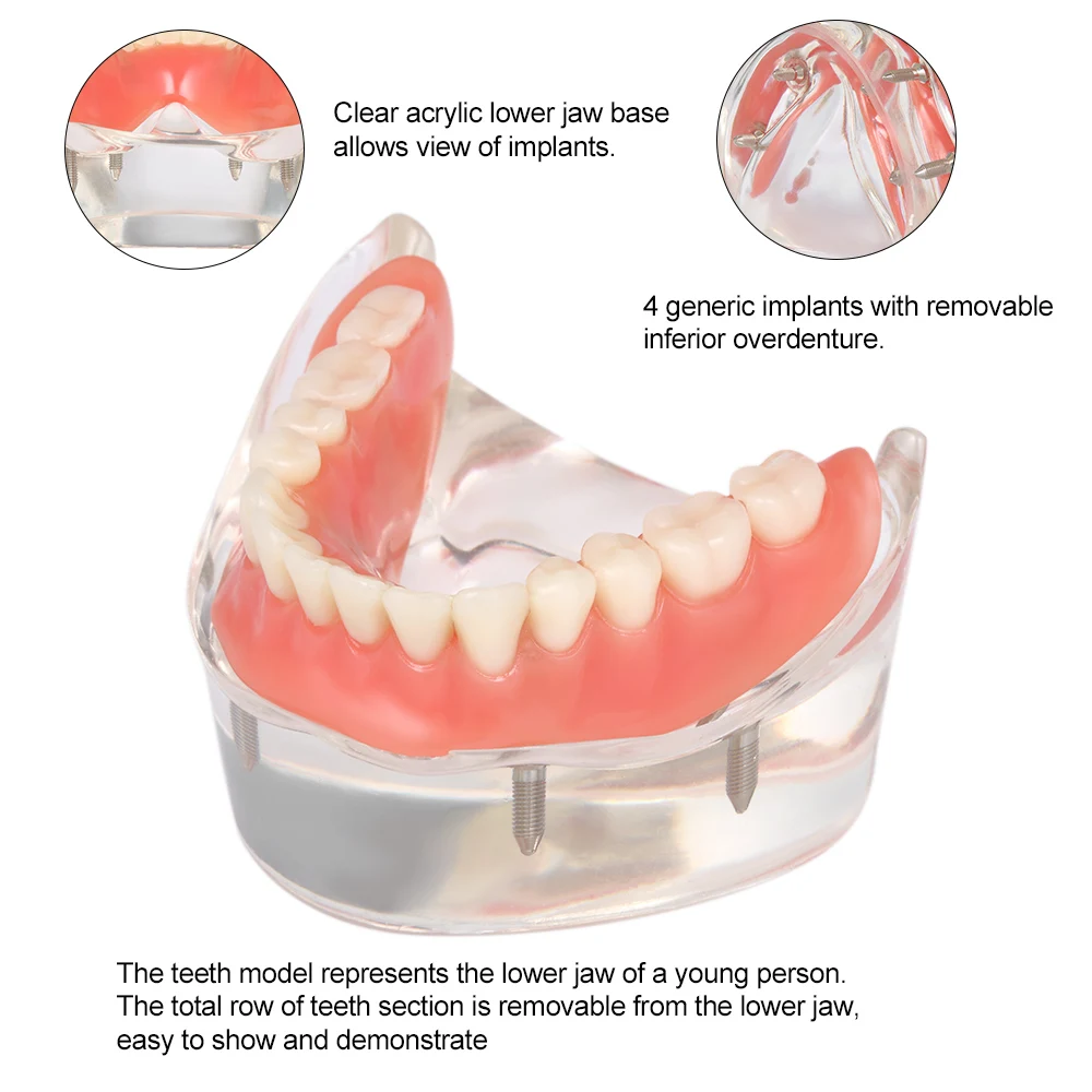 Зубные нижних зубов Модель протеза подкладке нижней челюсти с 4 имплантатов восстановление зуб медицинское зубные зубы исследование Teach