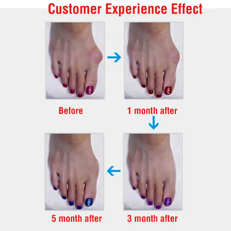 1Pair Silicone Toe Separator Bunion Adjuster Thumb Hallux Valgus Protector Health Care Pedicure Corrector Feet Massager Orthotic