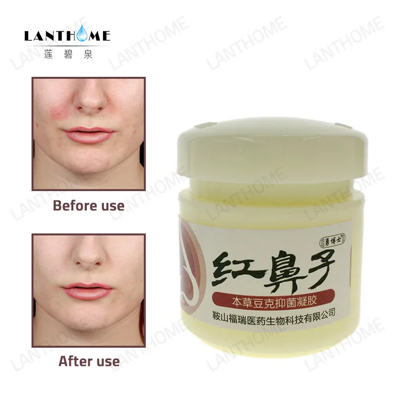 Herbal Medicine Rosacea Treatment Cream Red Nose Anti Acne Rosacea