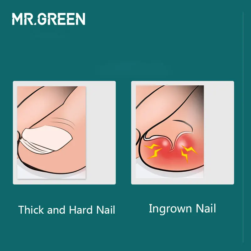  MR.GREEN nail ditch special nail clippers eagle mouth nail clippers large pedicure thick gray toe n