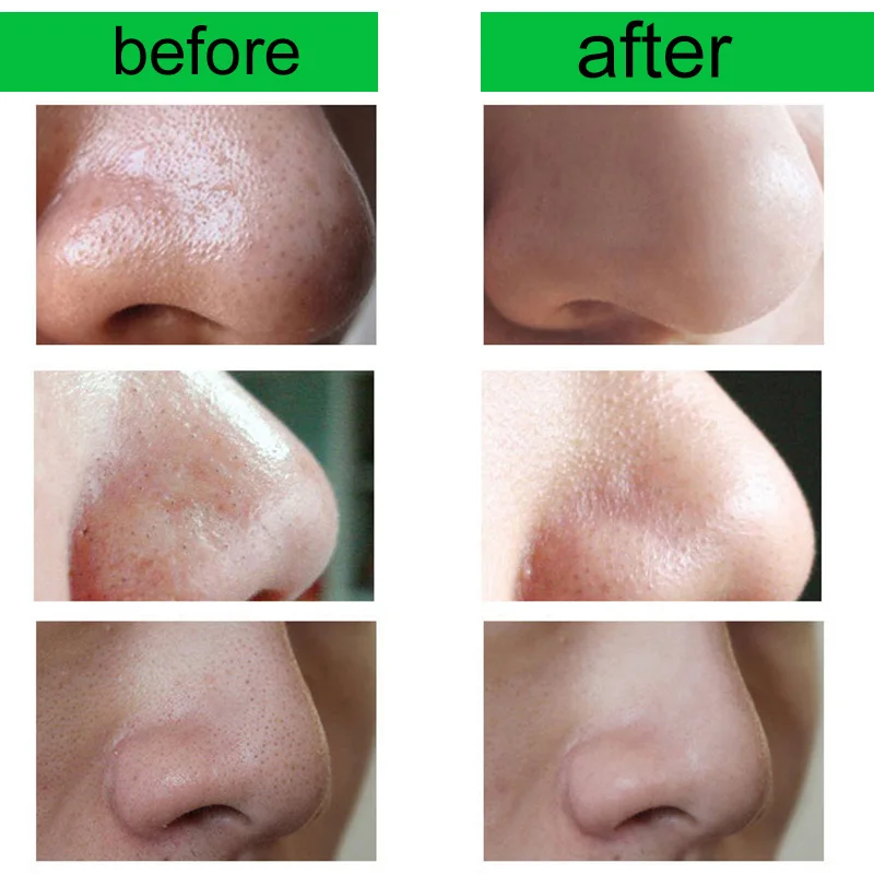 Hot Sale Nose Blackhead Black Head Remover Cream Aloe Vera Healing Gel Skin Burns Damage Repair Mask Skin Care