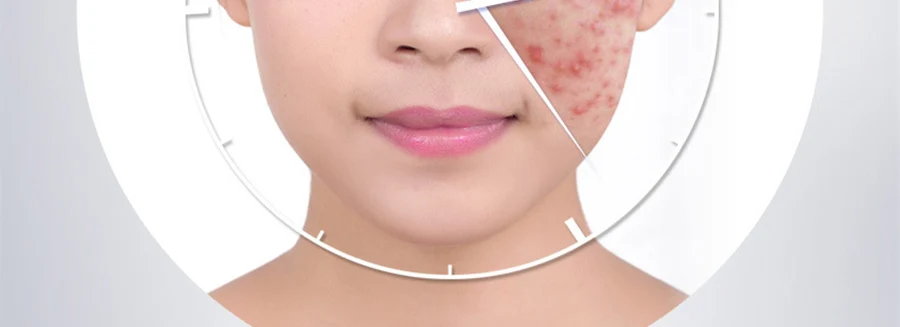 Австралия Чай дерево лечебные гель для лица Acne крем для сухой кожи, акне кожи лекарств лечение акне уход за кожей для угрей