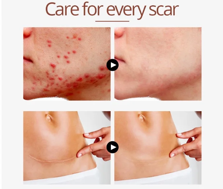 crocodile oil for stretch marks