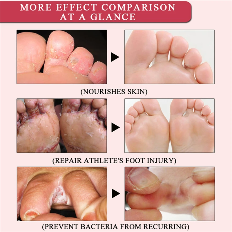 Крем для педикюра, пятки, ремонт, анти трещина, отбеливающий крем, пилинг для ног, трещины рук, ноги, сухая кожа, увлажняющий уход, средство для удаления мозолей