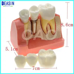 Макро имплантатов зубов Модель Корона мост demostratation зубы tooh Typodont dentoform