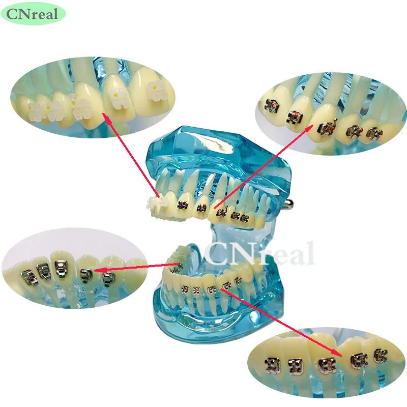 1 piece Dental Teeth Model Orthodontic 4-type Brackets Contrast Metal/Ceramic/Lingual/Self-ligating 1 piece Dental Teeth Model Orthodontic 4-type Brackets Contrast Metal/Ceramic/Lingual/Self-ligating