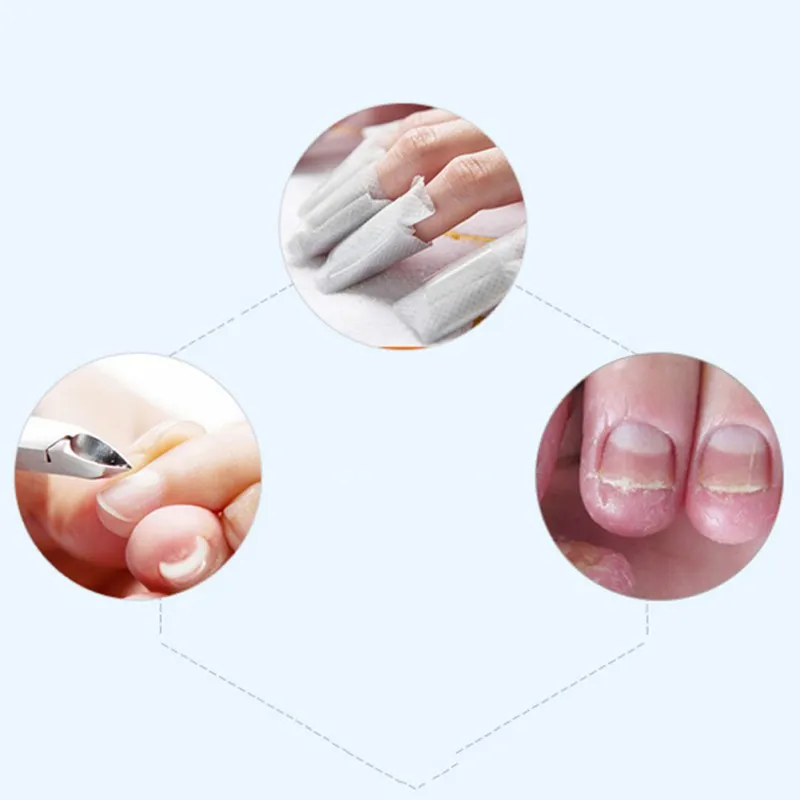 Fungal Nail Treatment Pen Effective Onychomycosis Paronychia Fungus Infection Repair Solution Gel Fingernails Toenails Care 3ml