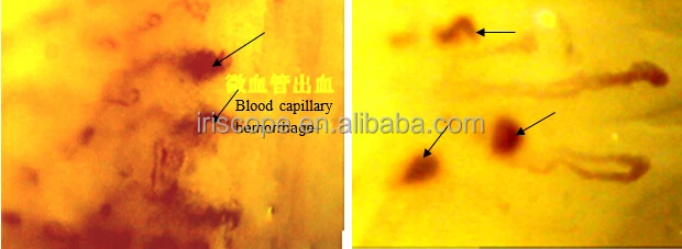 Крови микроциркуляционный микроскоп/лак для ногтей-fold капиллярные микроскоп