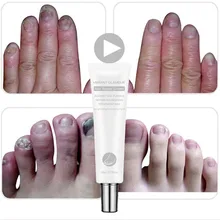 Уход за ногтями ноготь ремонт крем для ногтей грибок лечение Onychomycosis удаление противогрибковый крем для ногтей