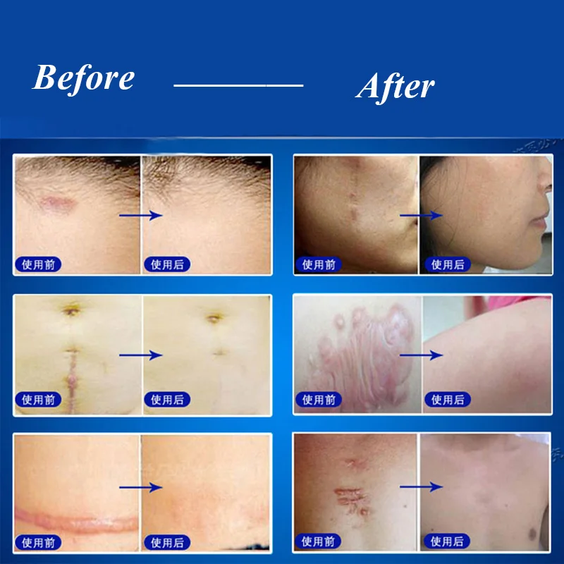 Clando Ful Skin Scar Remover Surgery Products Anti Acne Surgery Scar Products Anti Acne