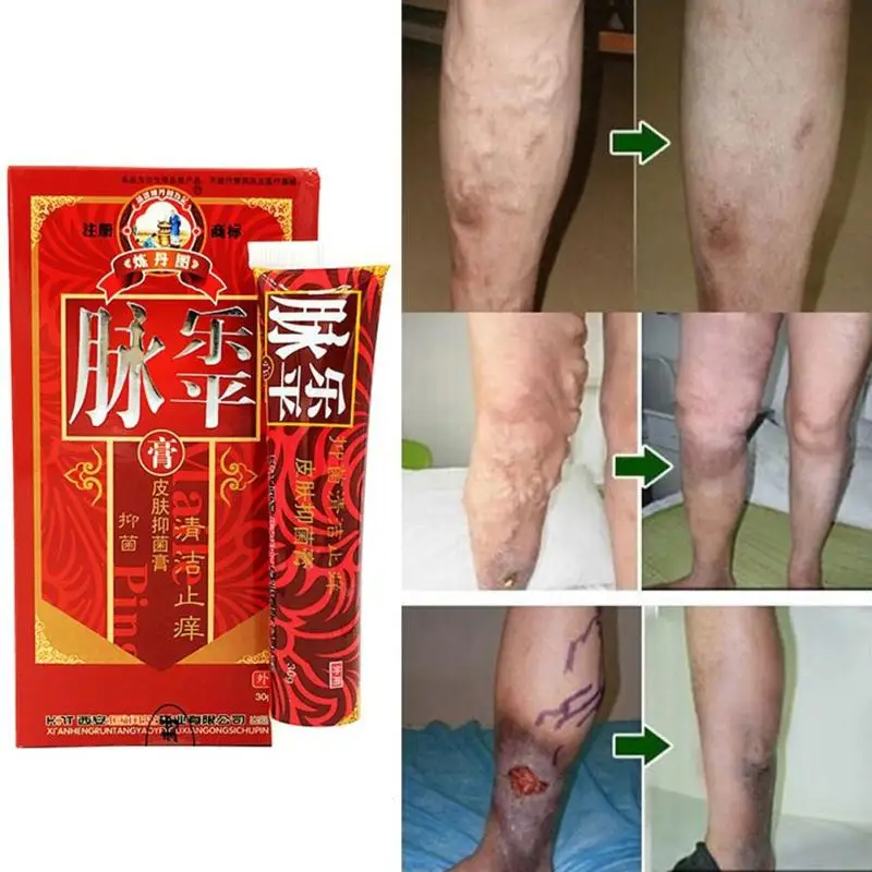 Chinese natural herbal medicine for treating varicose vascular
