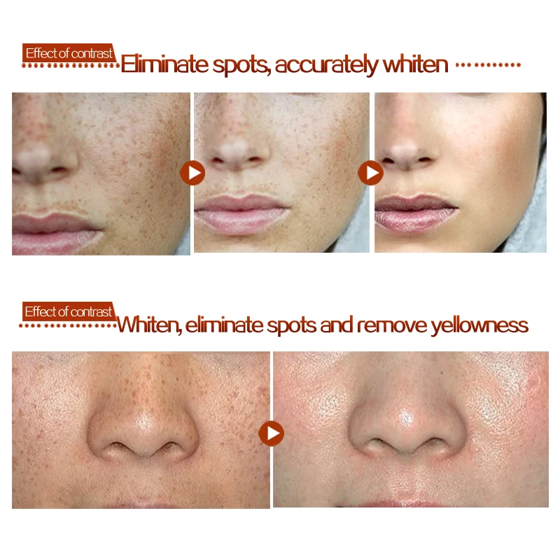 age spot cream