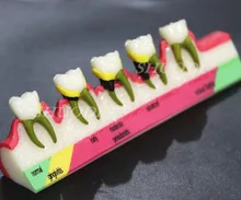 Dental Teeth Model Periodontal Disease Assort Tooth Classification Model resin oral periodontal disease classification model gingivitis degree chronic periodontitis model