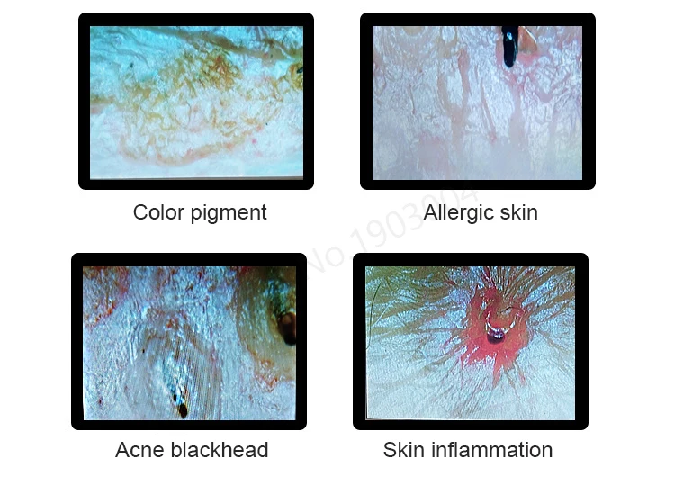 Анализатор состояния кожи головы волосяные фолликулы для лица анализатор волос машина цифровой дермоскопия уход за кожей красота Обнаружение здоровья кожи 200X