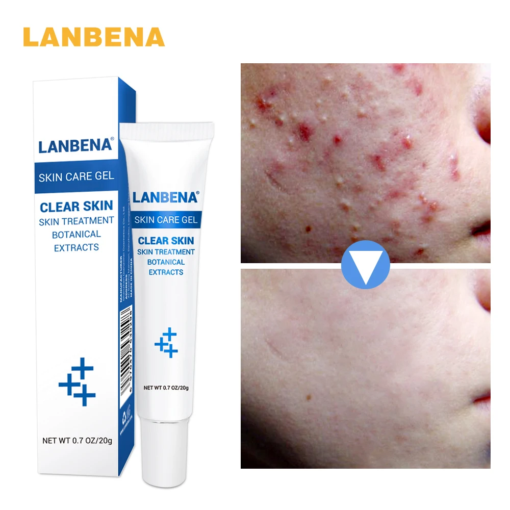 

LANBENA Anti Acne Moisturizing Gel cream Oil Control Shrink Pores oily skin Acne Spots Face skin care repairing Shrink Pores