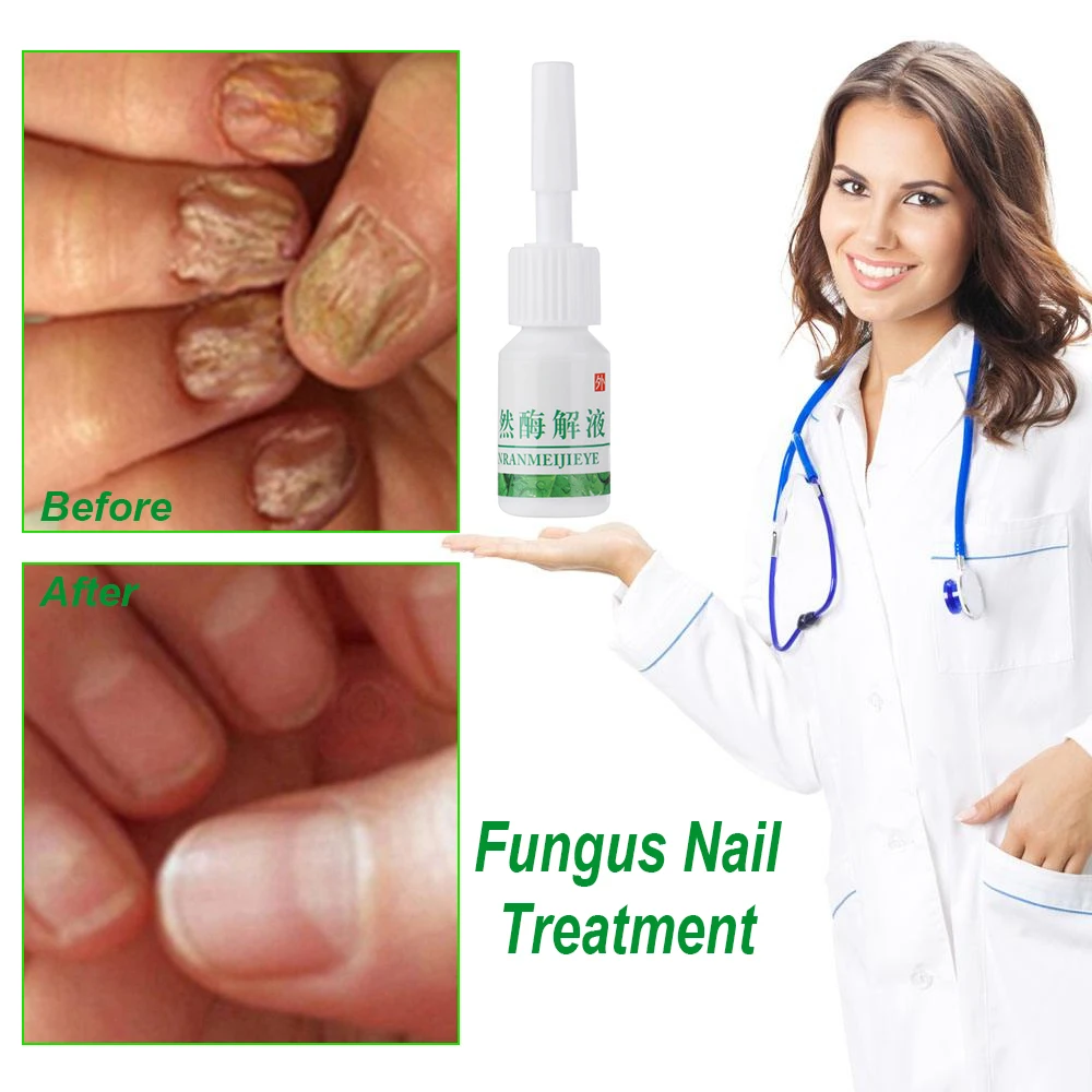 1 Bottle 4ml Fungal Nail Treatment Liquid Bright Nail Repair