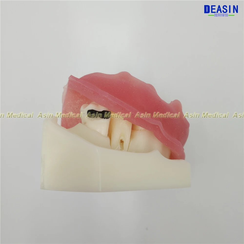 Modelo de Aprendizagem Modelo de Doença Deasin Novo Dentista Periodontal Dente - Modelo Médico 6 Clareamento dos dentes
