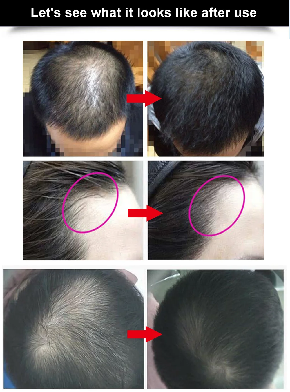 AMEIZII 2 шт эссенция для роста волос, продукты для роста волос, эфирное масло, жидкое лечение, предотвращение выпадения волос, уход за волосами, 20 мл