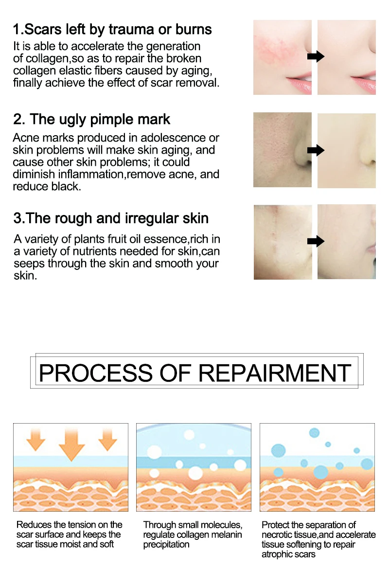 Розалинд шрам и акне mark удаления противовоспалительное и ремонт кожи Крем женьшень суть гель для ухода за кожей мазь