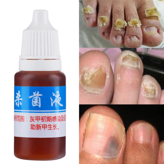 Good Result Nail Treatment Pen Onychomycosis Paronychia Anti Fungal