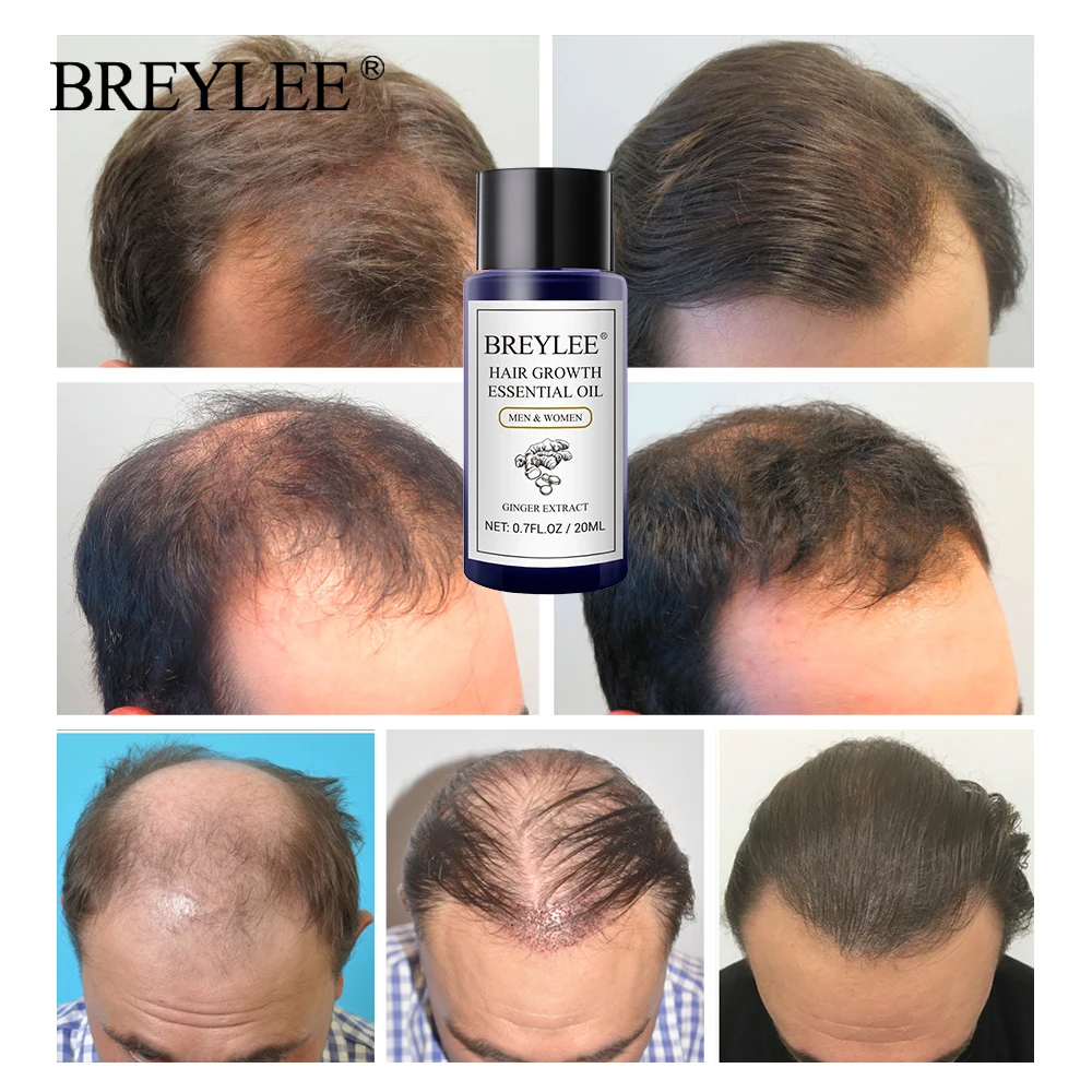 BREYLEE 2 шт. эфирное масло для роста волос быстро мощные Продукты для волос уход за волосами Предотвращение облысения против выпадения волос сыворотка для увеличения волос