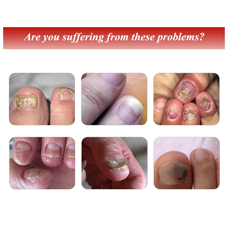 Лак для ногтей Уход восстановление эссенция для ногтей и ног Уход за кожей рук отбеливание гвоздь с широкой шляпкой анти удаление грибка инфекции Гель-лак для ногтей, SQ11