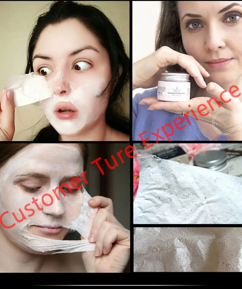 blackhead_02