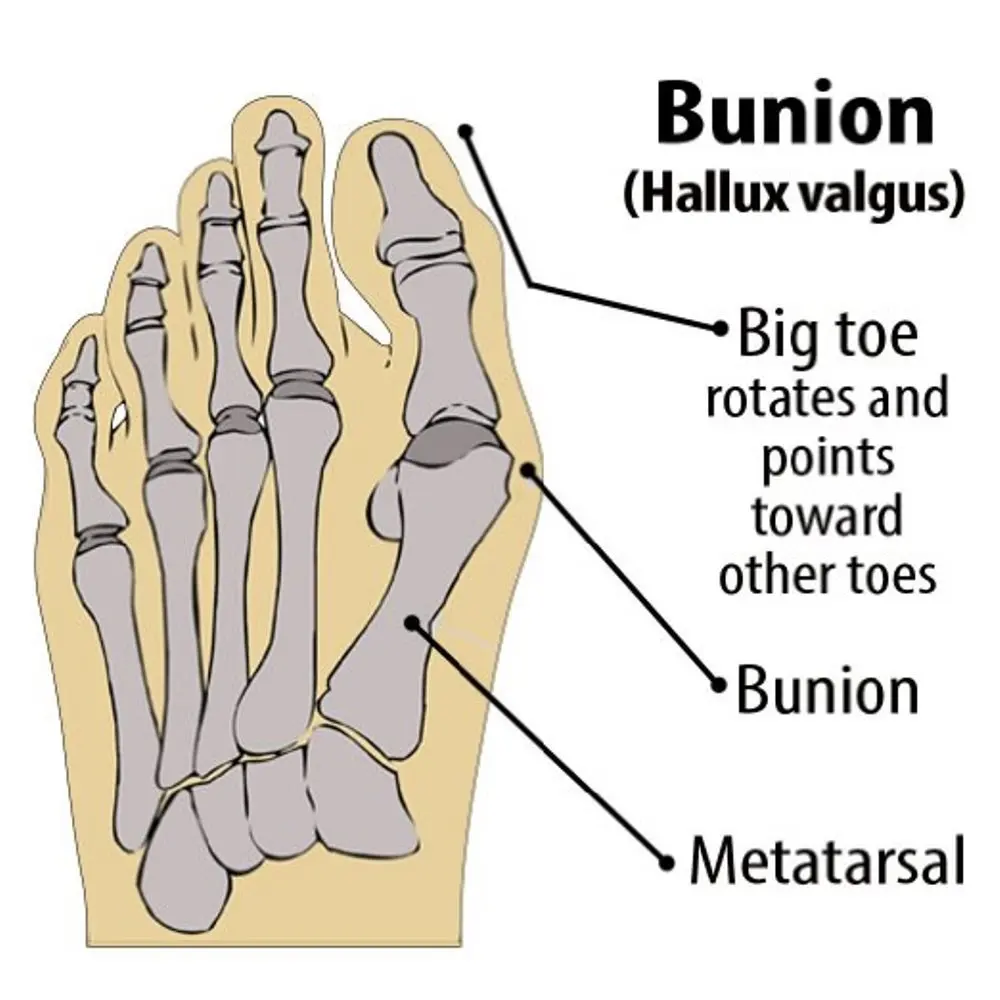 1 пара Выпрямитель для пальцев ног Уход за ногами Hallux стопа с вальгусной деформацией боль фиксируется большой палец ортопедические вальгусные Брекеты для коррекции рельефа