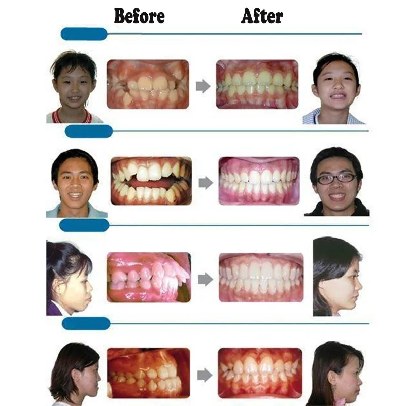1 шт. детский ортодонтический тренажер для зубов Ортодонтические брекеты прибор тренажер для выравнивания зубов брекеты мундштук уход за полостью рта