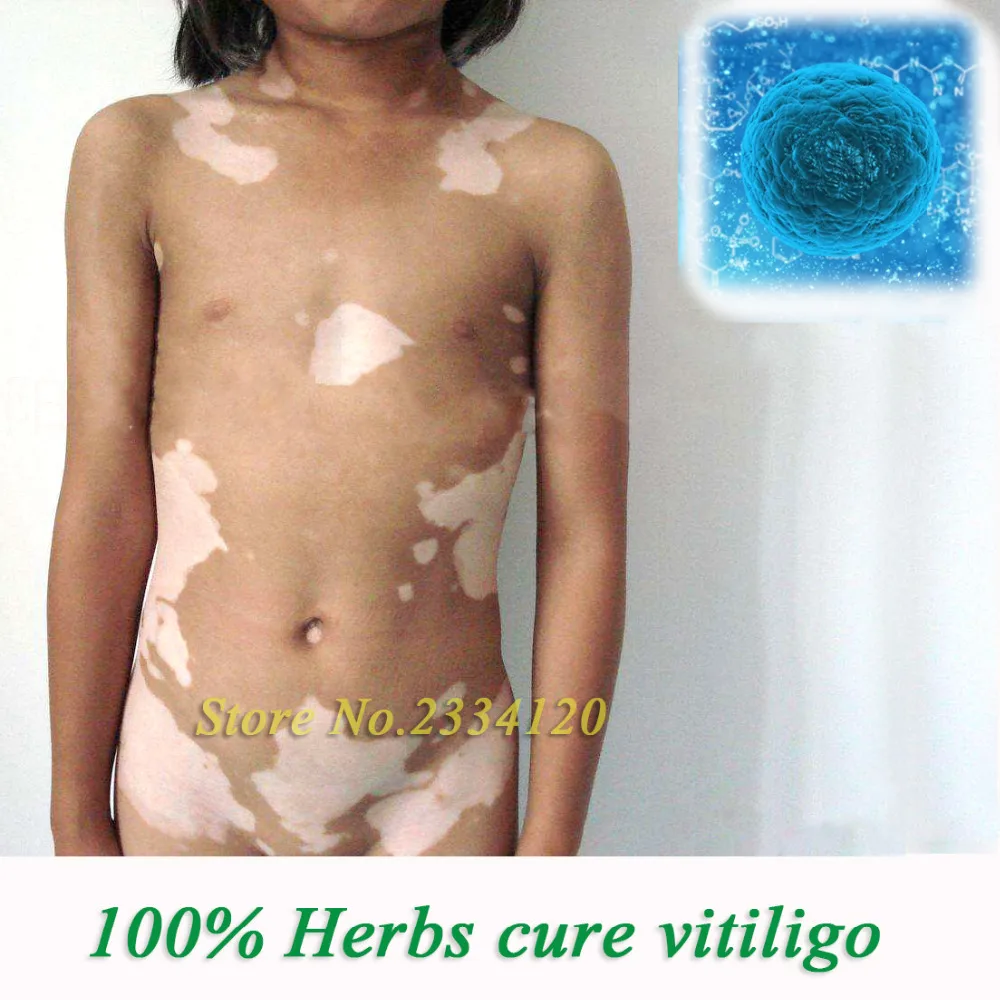 

100% herbs cure vitiligo skin liquid repair melanin white spot treatment pigment melanin promoting liniment