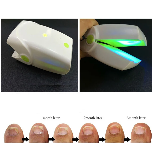 

Fingernails Toenails Toe Nail Fungus Cold Laser Therapy Onychomycosis Treatment Device Instrument Anti Fungal Rechargeable LLLT