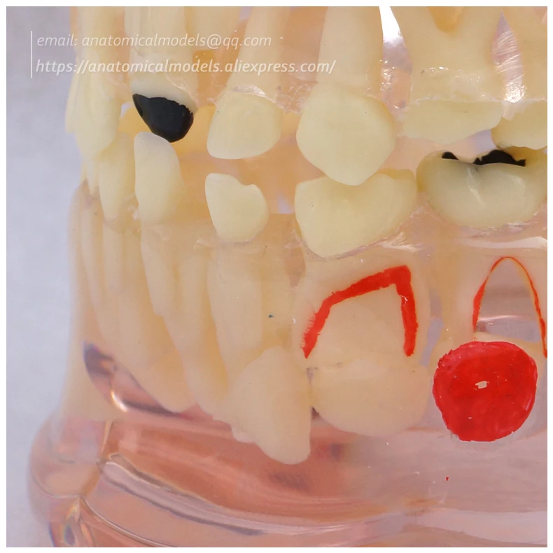 13062 Clear Mixed Age model with Caries 