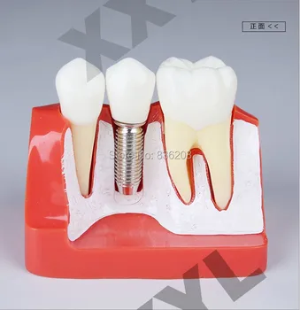 

Dental lab equipment teethwhitening Dentist oral hygiene Human skull skeleton anatomical Implant Analysis Crown Bridge Model