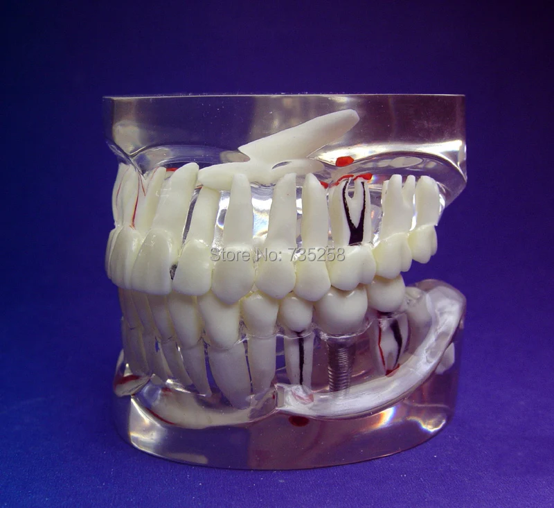 

Transparent 1:1 Adult Teeth Pathology Model,Adult Tooth Pathological Planting Practice Model