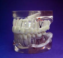Transparent 1 1 Adult Teeth Pathology Model Adult Tooth Pathological Planting Practice Model