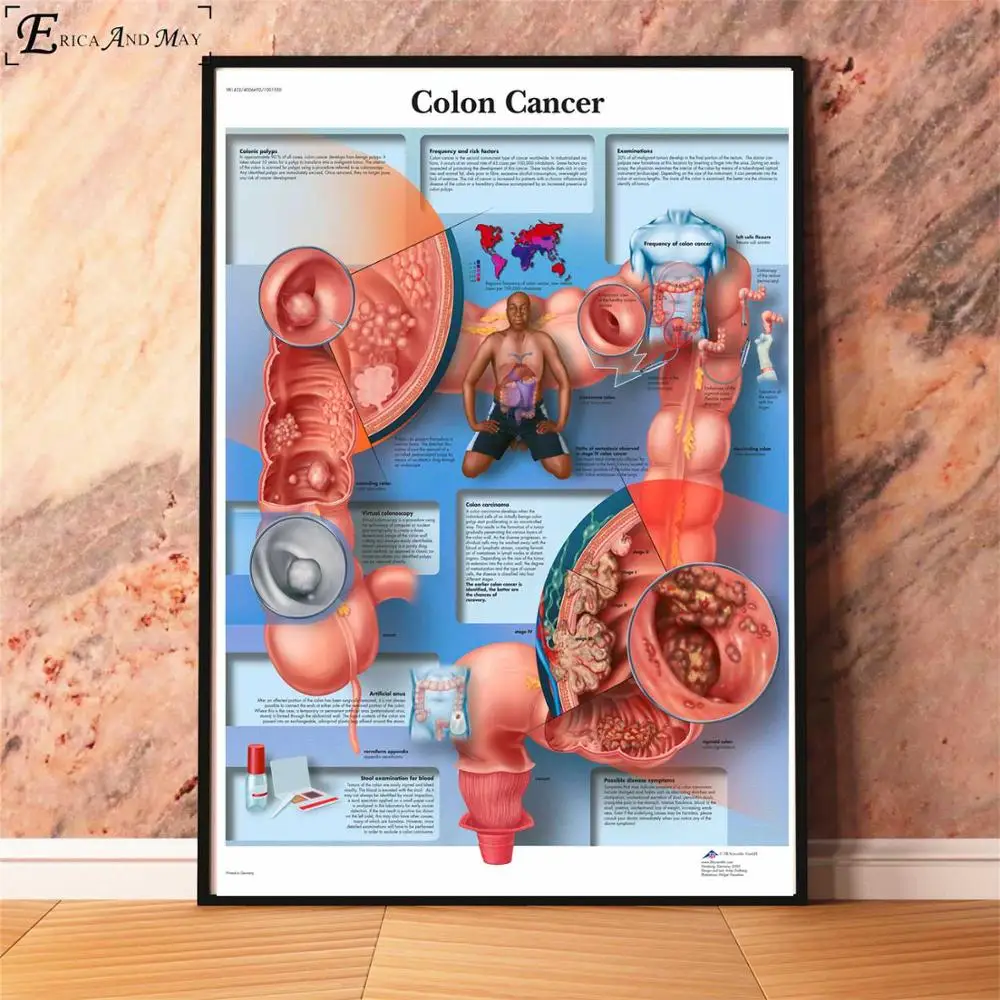 Анатомия болезни патологии диаграмма картина, печатный плакат декоративные настенные картины для комнаты без рамки украшения дома аксессуары - Цвет: Colon Cancer